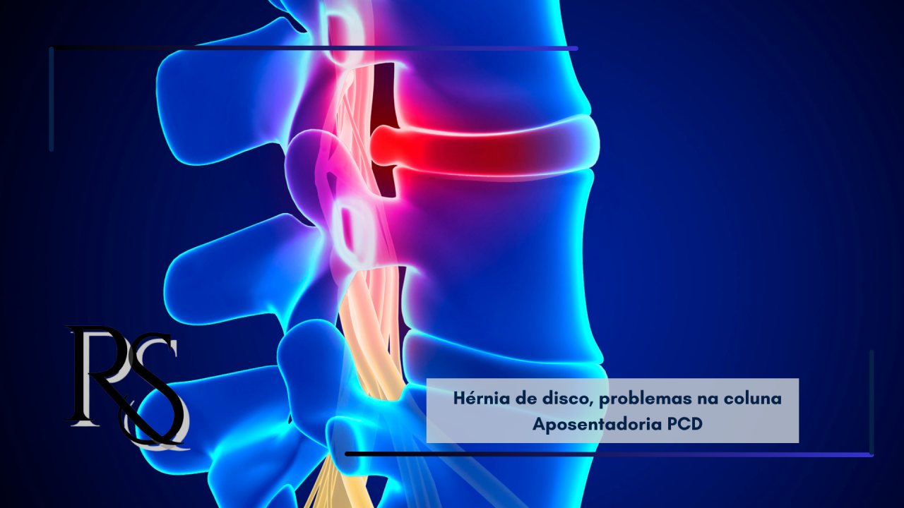 Hérnia de disco e problemas na coluna podem dar direito à aposentadoria PCD?