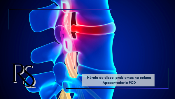 Hérnia de disco e problemas na coluna podem dar direito à aposentadoria PCD?